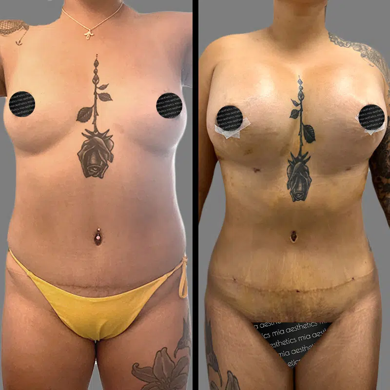 Dr. Xu Mommy Makeover - Before & After 1