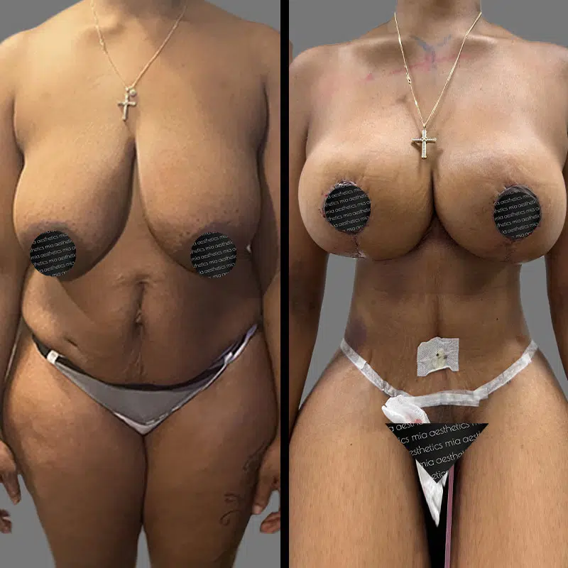 Dr. Xu Mommy Makeover - Before & After 3