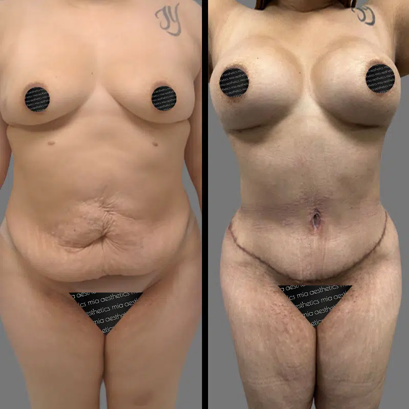 Dr. Xu Mommy Makeover - Before & After 4