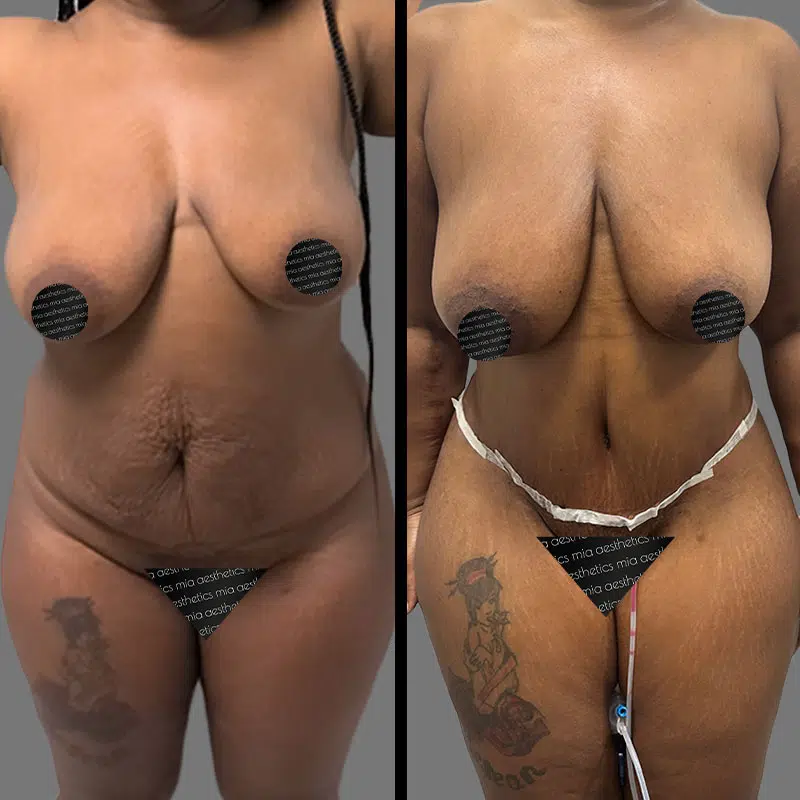 Dr. Xu Tummy Tuck - Before & After 1