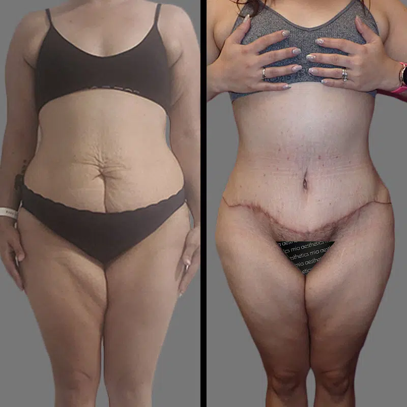 Dr. Bronstein Tummy Tuck - Before & After 4