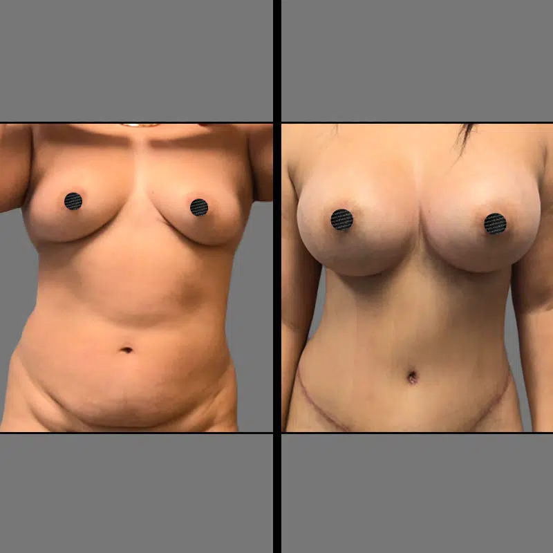 Dr. Charepoo Breast Procedure - Before & After 2