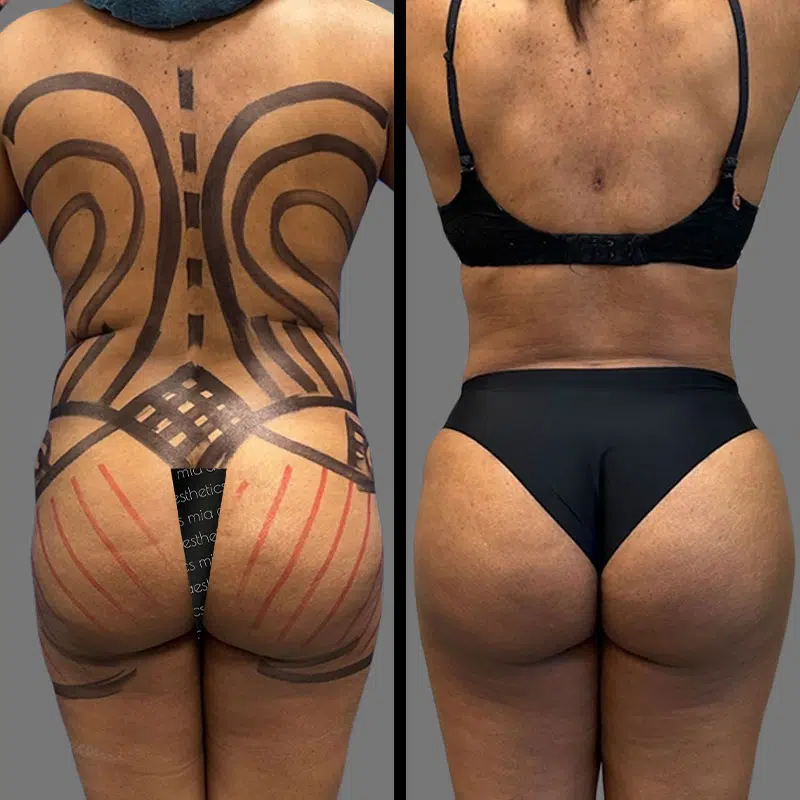 Dr. Fasusi BBL - Before & After 2