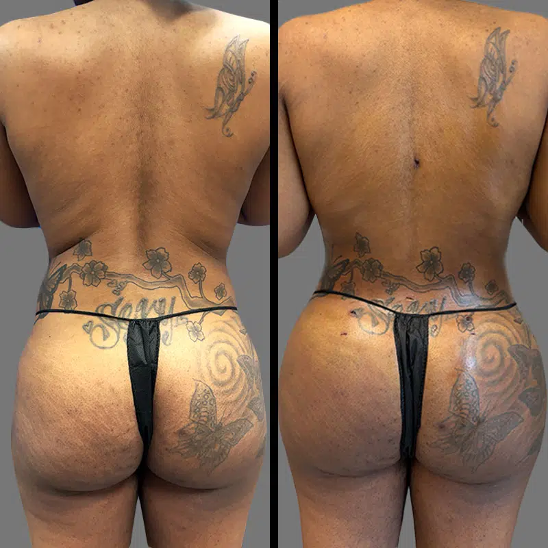 Dr. Fasusi BBL - Before & After 3