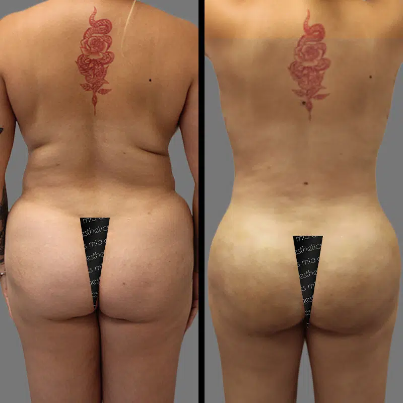 Dr. Fasusi BBL - Before & After 4