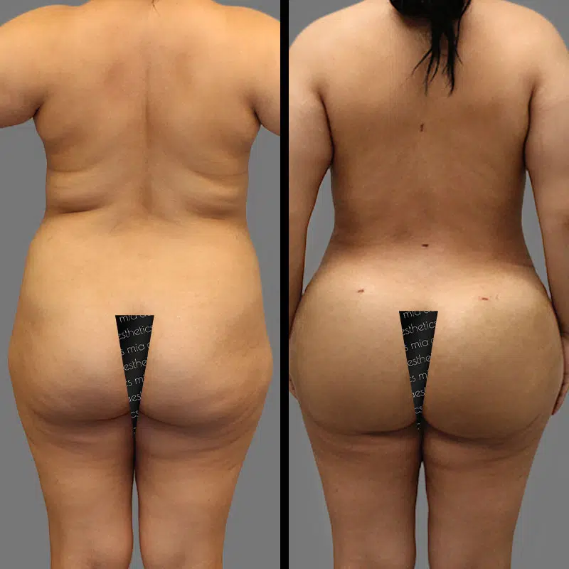 Dr. Fasusi BBL - Before & After 5