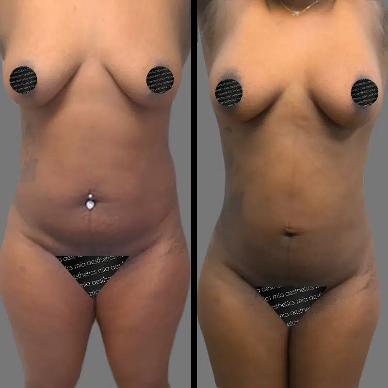 Dr. Fasusi Lipo 360 - Before & After 4