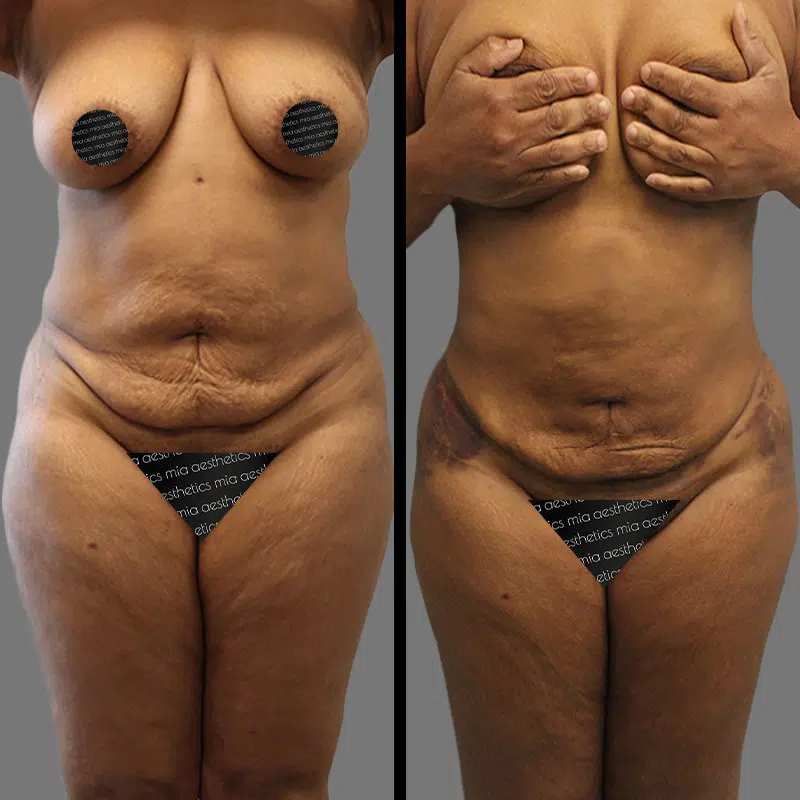 Dr. Fasusi Lipo 360 - Before & After 5