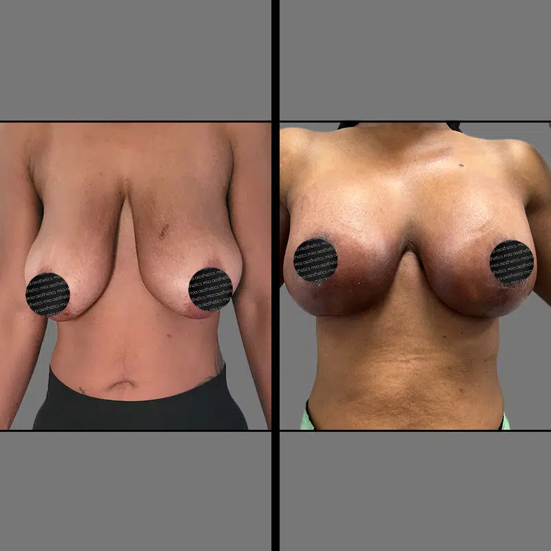 Dr. Giorgis Breast Augmentation & Lift - Before & After 4