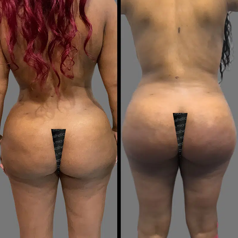 Dr. Giorgis BBL - Before & After 3