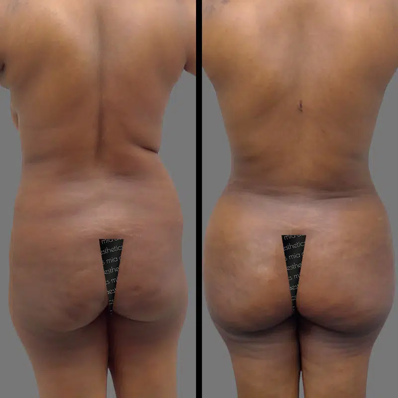 Dr. Giorgis BBL - Before & After 4