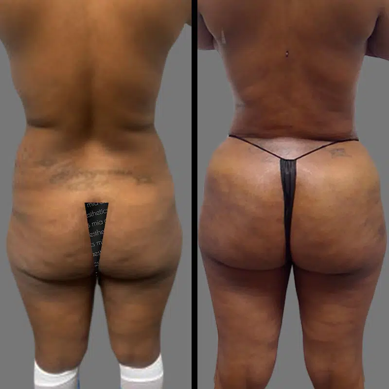 Dr. Giorgis BBL - Before & After 5