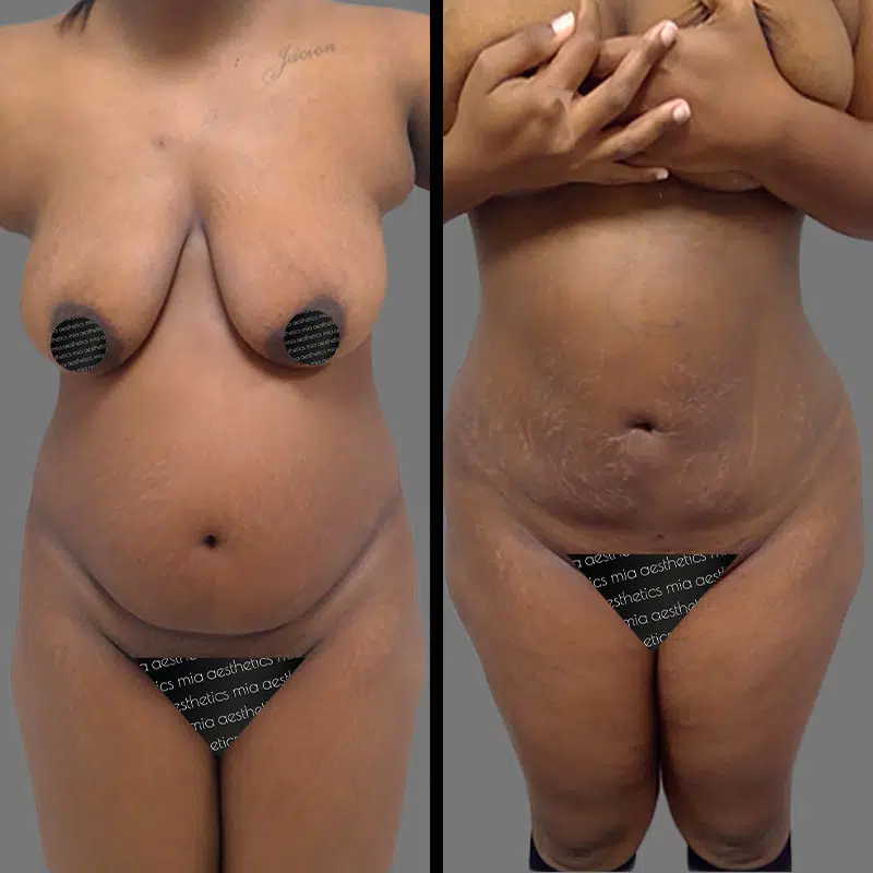 Dr. Giorgis Lipo 360 - Before & After 4