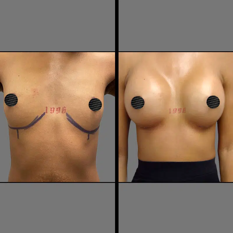 Dr. Gray Breast Augmentation - Before & After 2