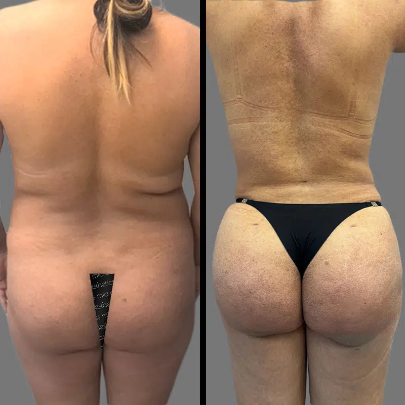 Dr. Gray BBL - Before & After 1