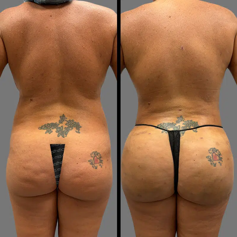 Dr. Gray BBL - Before & After 2