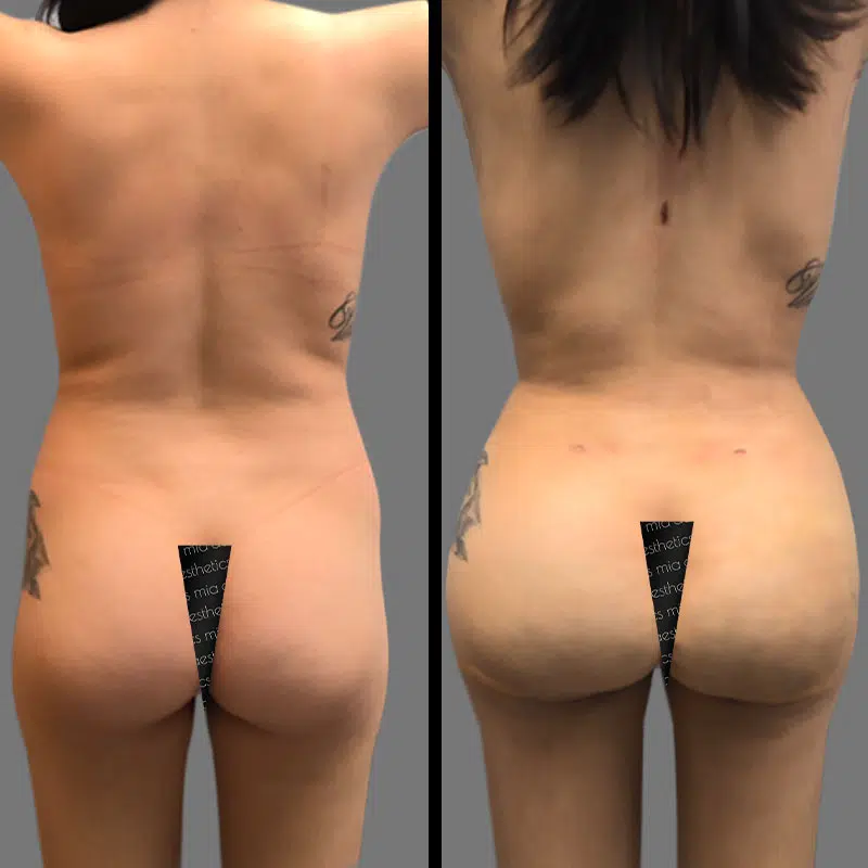 Dr. Gray BBL - Before & After 3