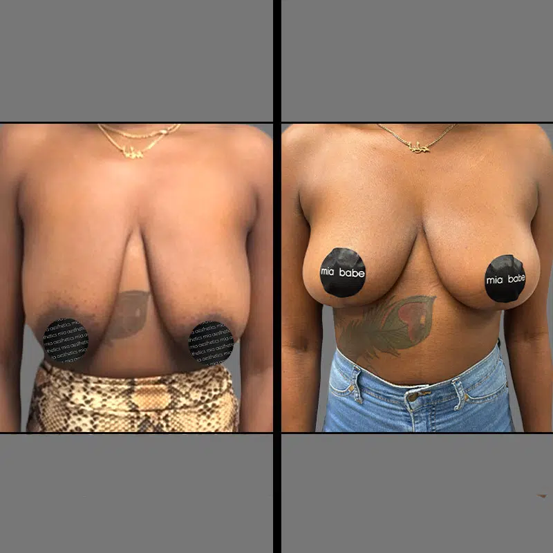 Dr. Gray Breast Lift - Before & After 3