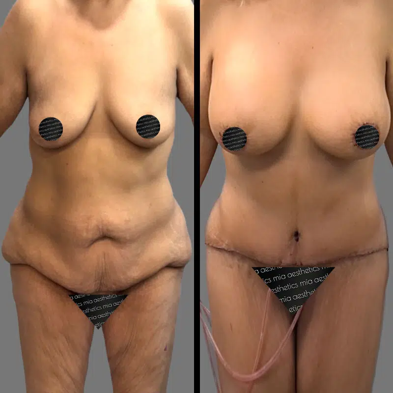 Dr. Gray Mommy Makeover - Before & After 1
