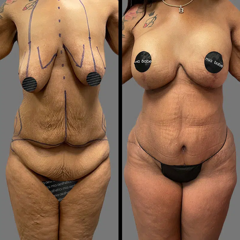 Dr. Gray Mommy Makeover - Before & After 2