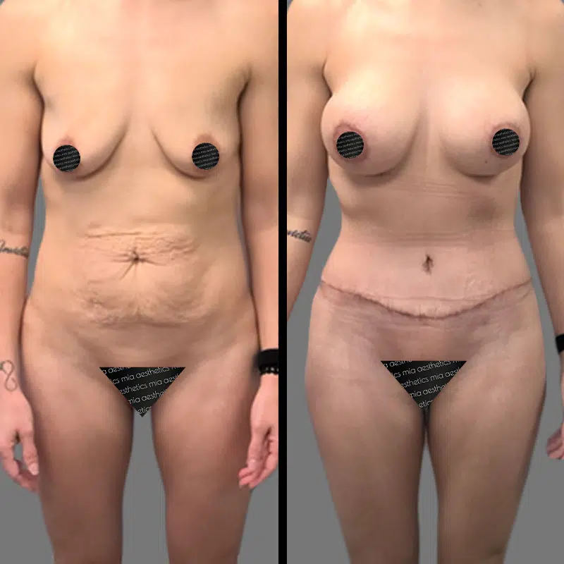 Dr. Gray Mommy Makeover - Before & After 2