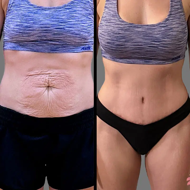 Dr. Gray Tummy Tuck - Before & After 1