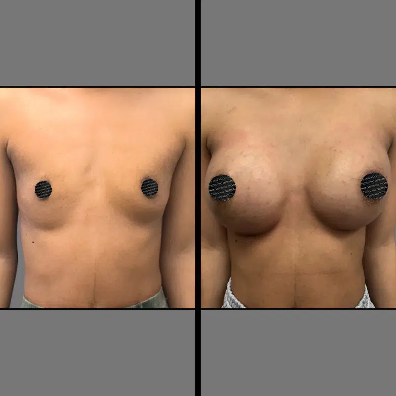 Dr. Gross Breast Augmentation - Before & After 1