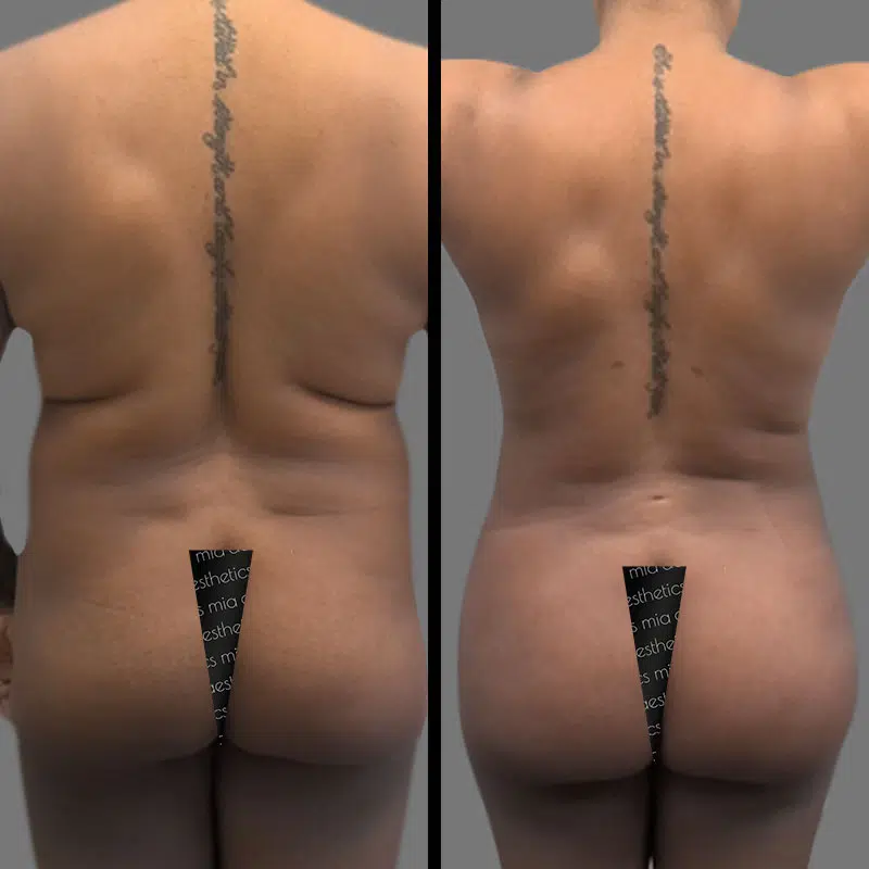 Dr. Gross BBL - Before & After 1