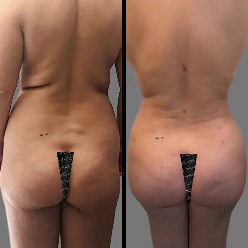 Dr. Gross BBL - Before & After 2
