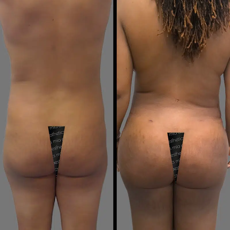 Dr. Gross BBL - Before & After 3