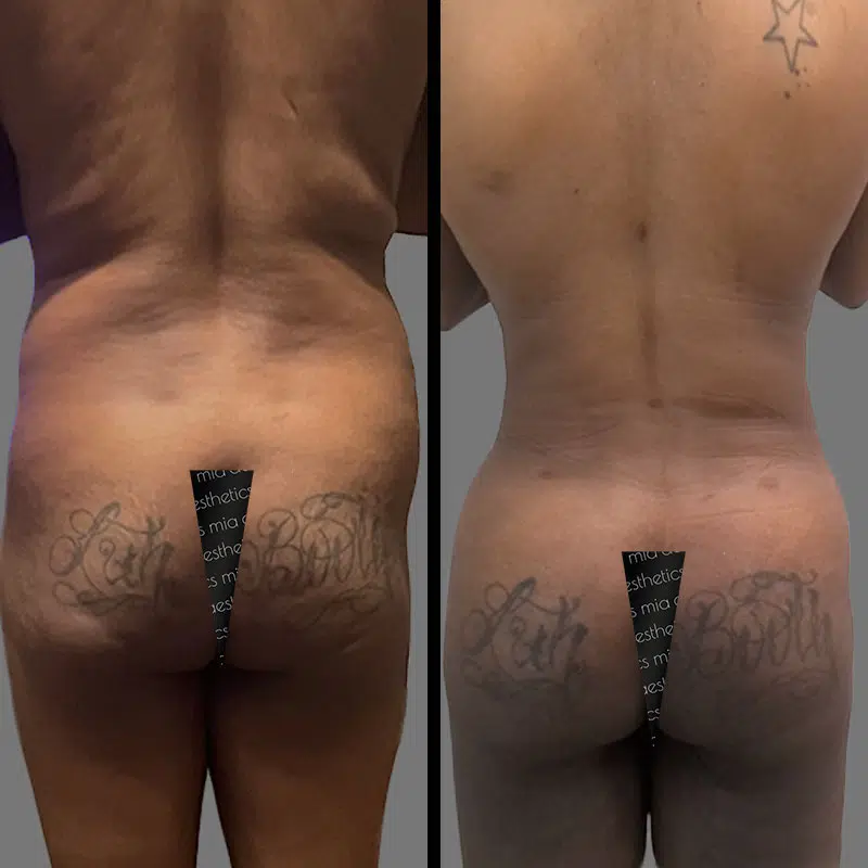 Dr. Gross BBL - Before & After 4