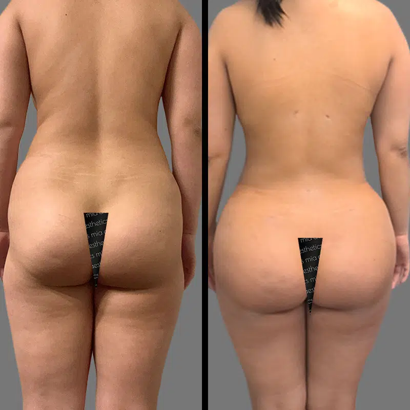 Dr. Gross BBL - Before & After 5
