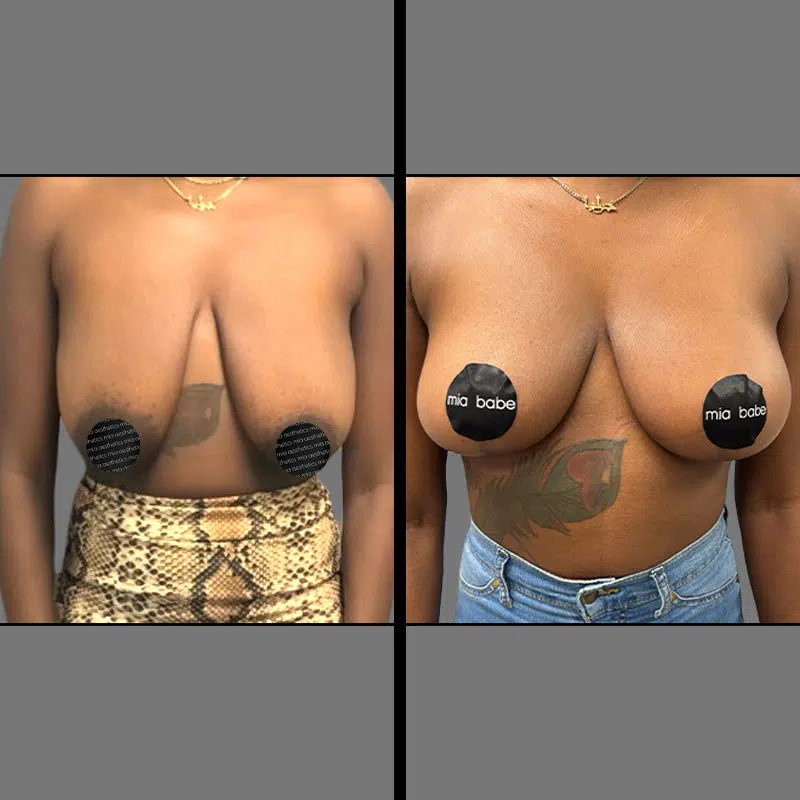 Dr. Gross Breast Lift - Before & After 3