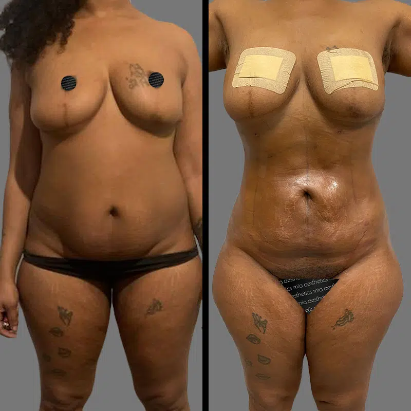 Dr. Gross Lipo 360 - Before & After 1