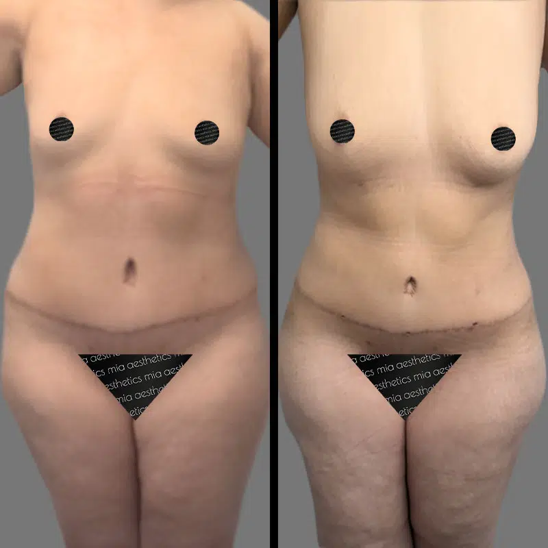 Dr. Gross Lipo 360 - Before & After 2