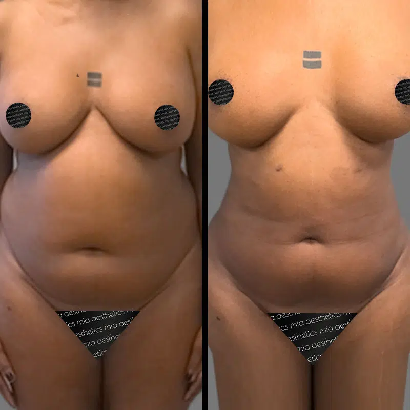 Dr. Gross Lipo 360 - Before & After 3
