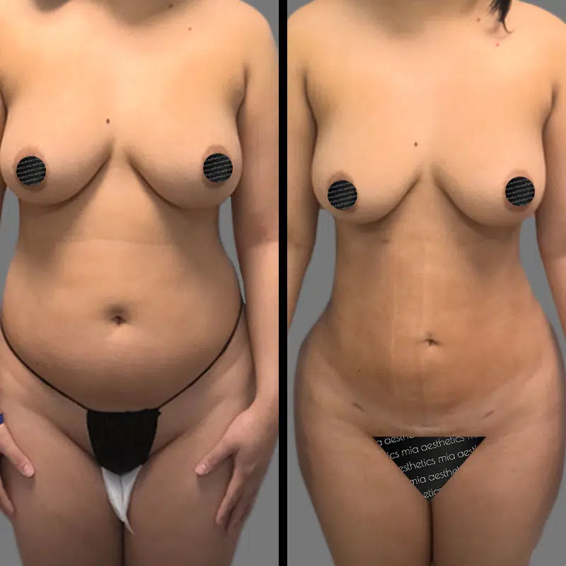 Dr. Gross Lipo 360 - Before & After 3