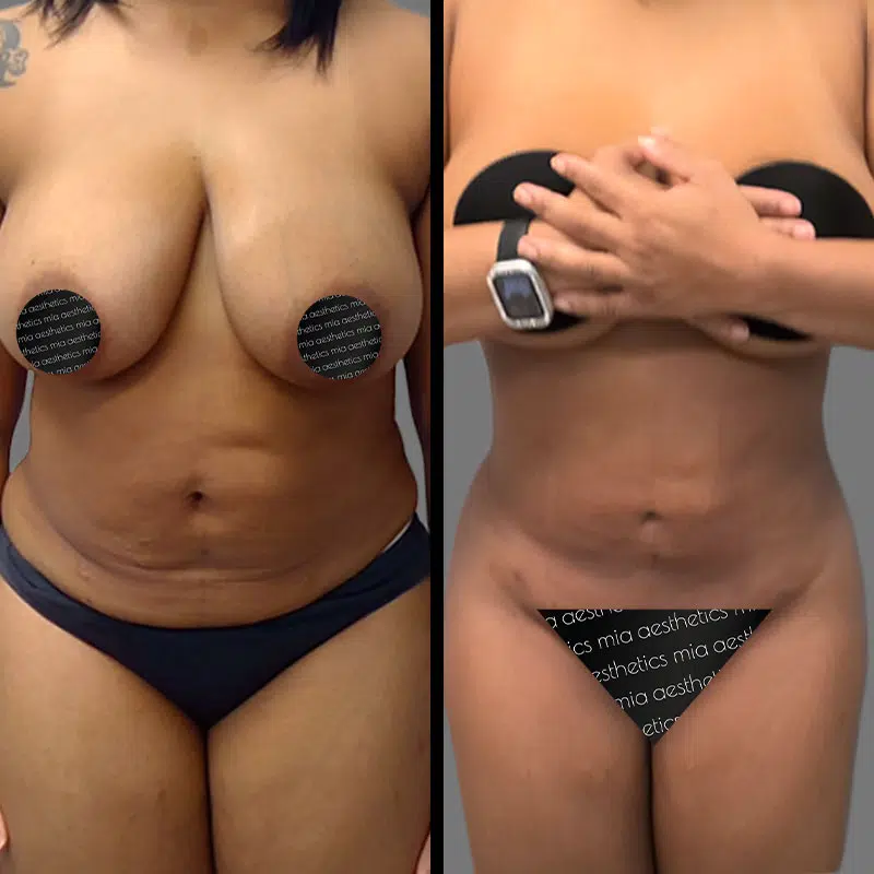 Dr. Gross Lipo 360 - Before & After 5
