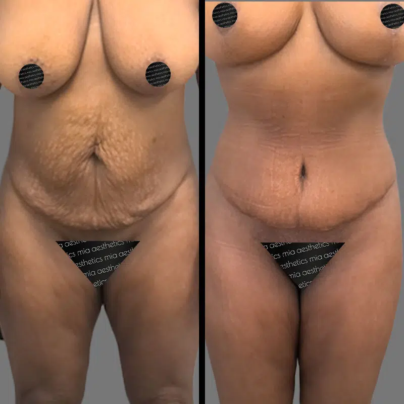 Dr. Gross Tummy Tuck - Before & After 2