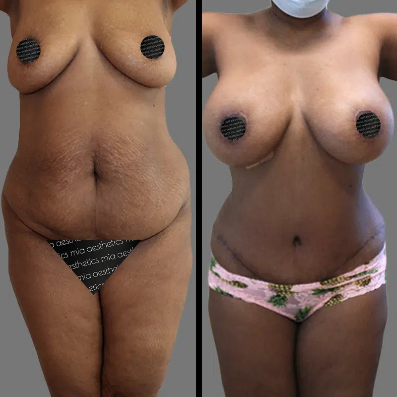 Dr. Horowitz Mommy Makeover - Before & After 3