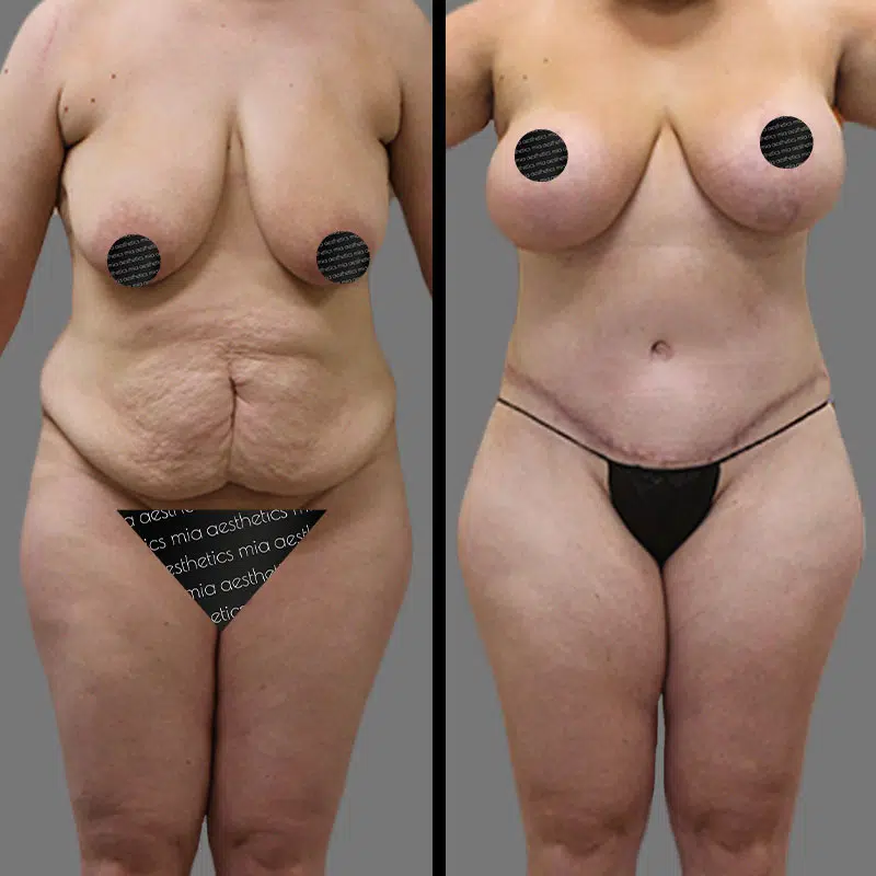 Dr. Horowitz Mommy Makeover - Before & After 3
