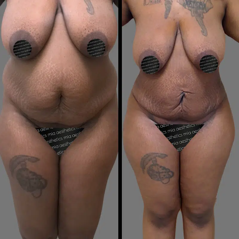 Dr. Kramer Lipo 360 - Before & After 4