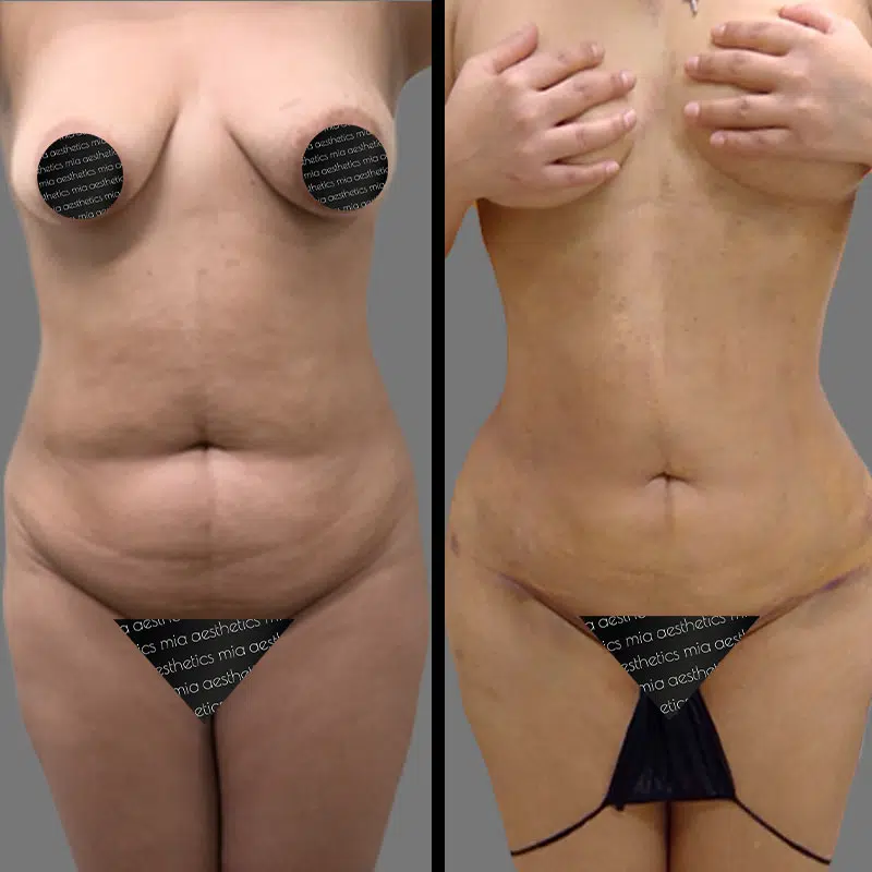 Dr. Kramer Lipo 360 - Before & After 5