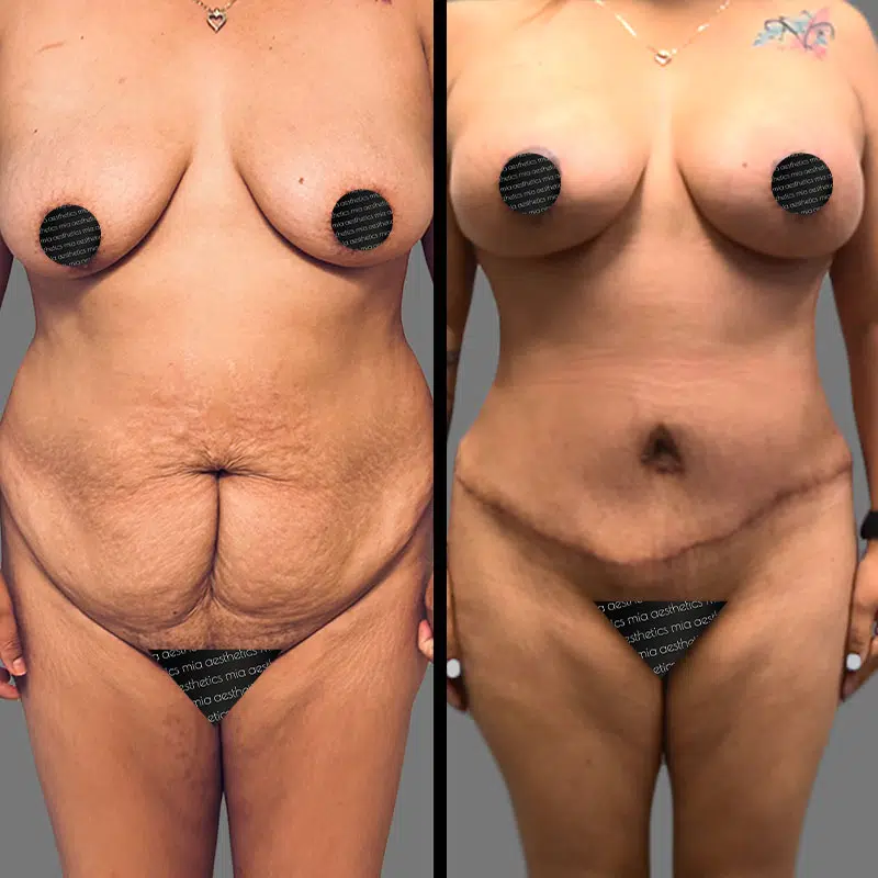 Dr. Morse Mommy Makeover - Before & After 1