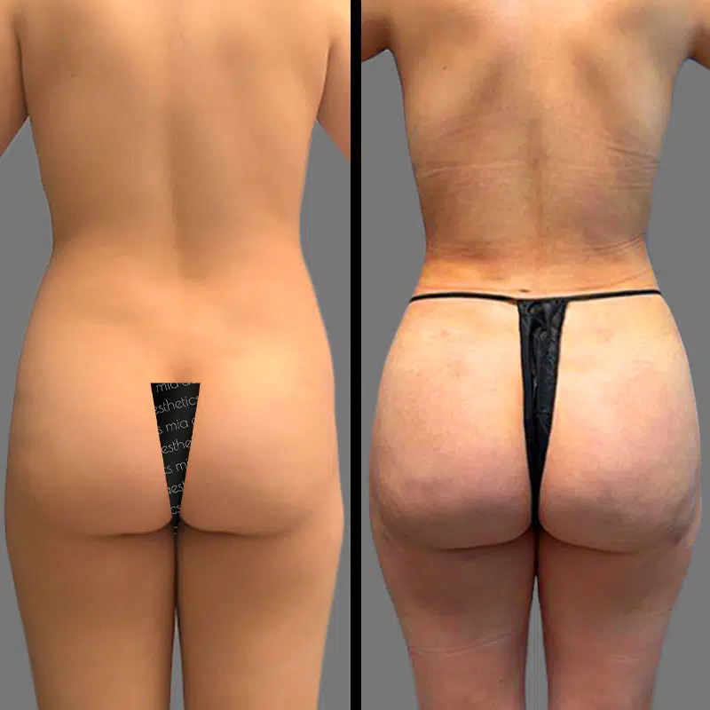 Dr. Orlando BBL - Before & After 2