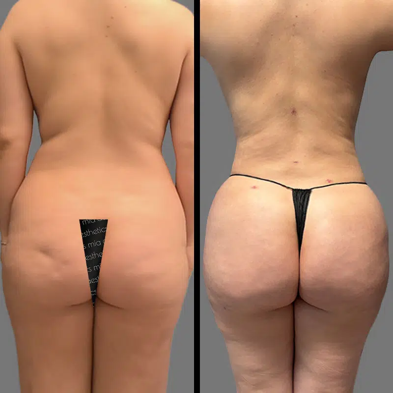Dr. Orlando BBL - Before & After 3