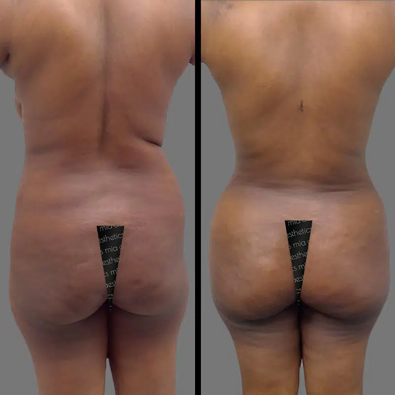Dr. Orlando BBL - Before & After 5