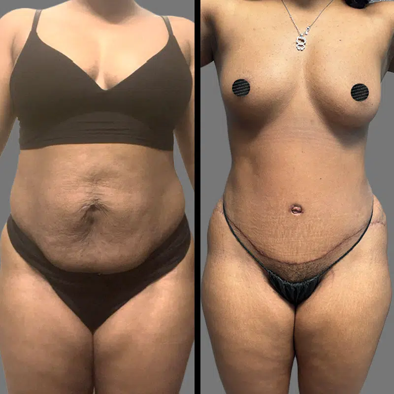 Dr. Orlando Tummy Tuck - Before & After 4
