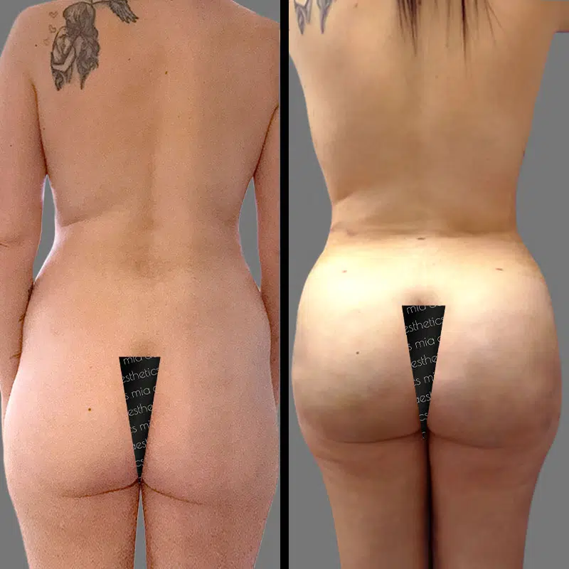Dr. Rozentsvit BBL - Before & After 2