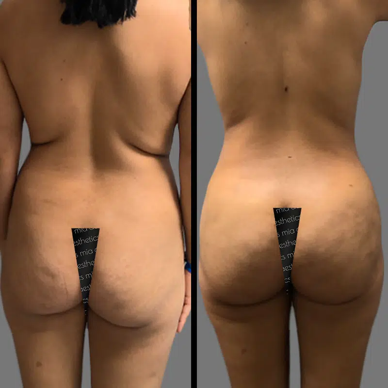 Dr. Rozentsvit BBL - Before & After 3